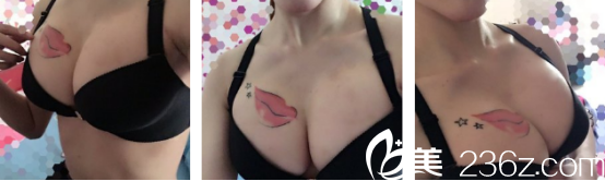 一天秤座妹子回忆在西安叶子医院做的假体隆胸感受