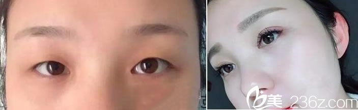 <!--<i data=20240703-sp></i>-->魏敬想医生双眼皮真人案例