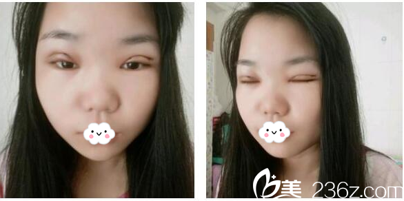 东莞美立方郑志敏双眼皮第二天