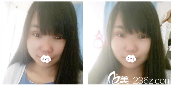 找东莞美立方郑志敏做双眼皮4天了