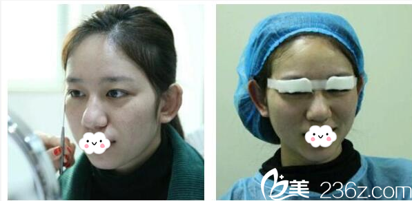 术前单眼皮照片 术前单眼皮照片