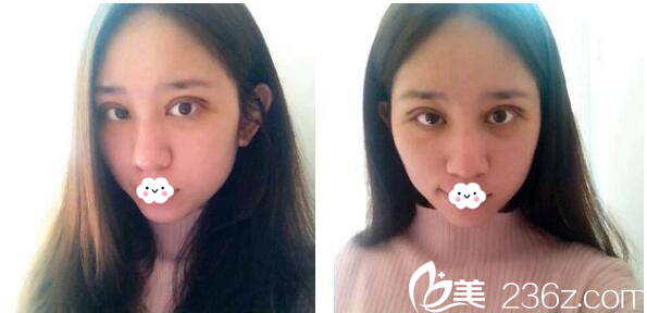 在东莞美立方做完双眼皮8天效果 在东莞美立方做完双眼皮8天效果