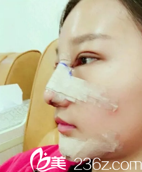 达州双均刘隆才给我做的假体隆鼻手术 达州双均刘隆才给我做的假体隆鼻手术