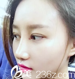 术后第七天样子已经有了