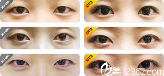 整形聂益军双眼皮案例