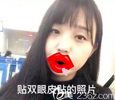 做双眼皮手术前贴眼皮贴的照片