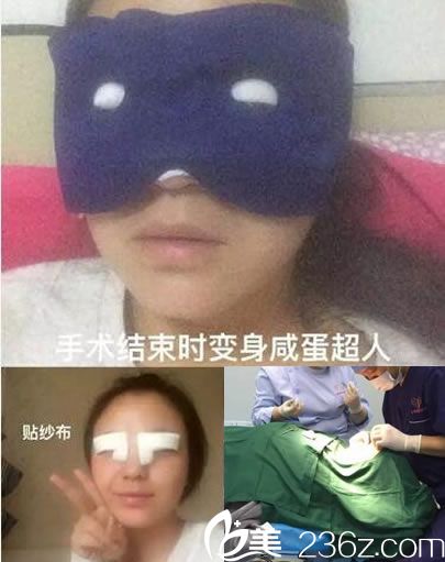 <!--<i data=20240703-sp></i>-->魏敬想做双眼皮手术过程