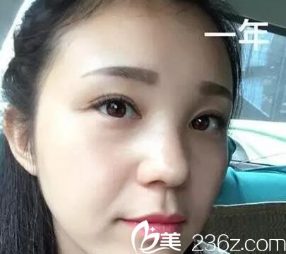 去年花5300元找做的双眼皮和开眼角手术恢复效果还算满意