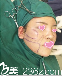 准备面部吸脂时的照片 准备面部吸脂时的照片