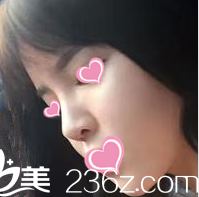 术后一个月的样子 术后一个月的样子