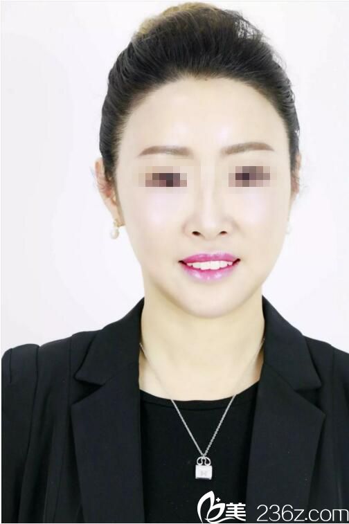 武汉唯韩内部员工真人案例：她只做了个面部年轻化就能如此美丽了