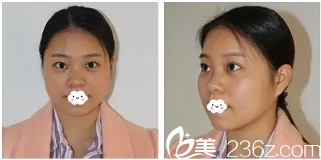 这是整形前的隆鼻和下巴特写 这是整形前的隆鼻和下巴特写