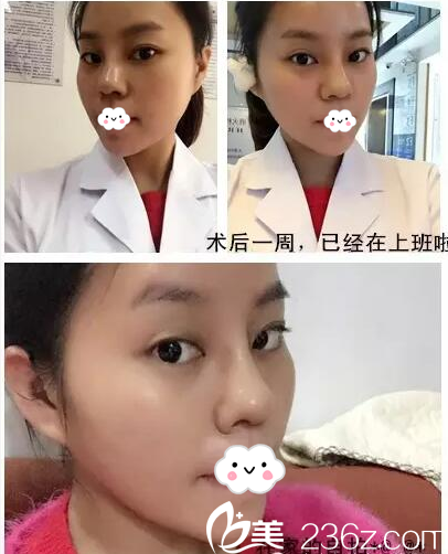 小雪隆鼻隆下巴术后一周恢复照片 小雪隆鼻隆下巴术后一周恢复照片