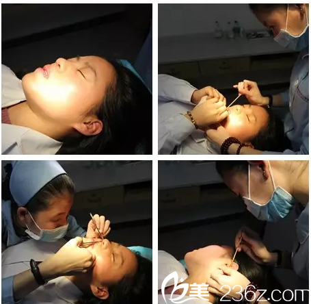 隆鼻8天小雪来江门华美拆线 隆鼻8天小雪来江门华美拆线