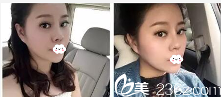 江门华美欧国升隆鼻隆下巴案例图 江门华美欧国升隆鼻隆下巴案例图