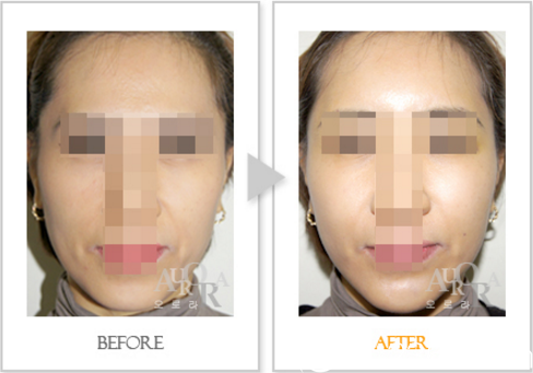 面部脂肪填充前后效果对比 面部脂肪填充前后效果对比