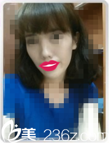 面部脂肪填充术前照 面部脂肪填充术前照