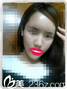 术后第三天效果 术后第三天效果