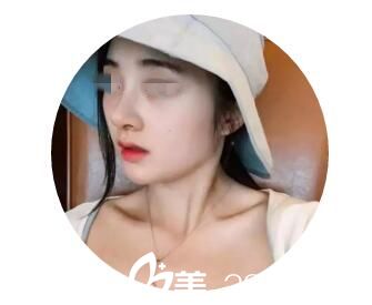术后7天效果