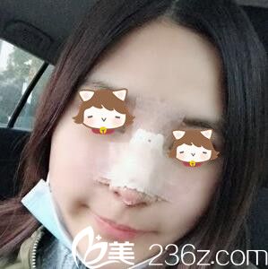 上海美莱医疗美容医院杜园园鼻综合真人案例术后第三天