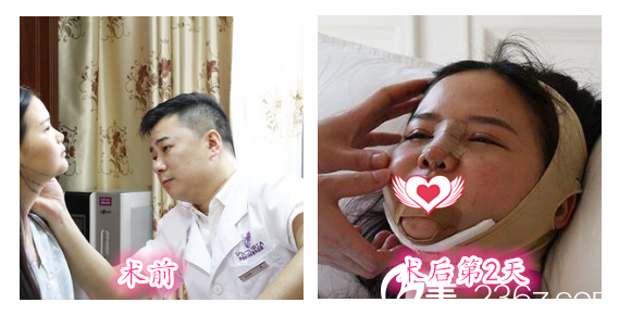 安徽维多利亚整形美容医院徐和林给我做术前设计及术后第2天照片 安徽维多利亚整形美容医院徐和林给我做术前设计及术后第2天照片