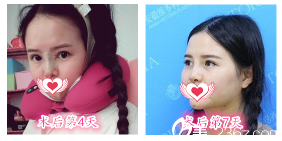 在安徽维多利亚做鼻综合+眼综合+下颌角整形术后第4天-第7天恢复过程图展示 在安徽维多利亚做鼻综合+眼综合+下颌角整形术后第4天-第7天恢复过程图展示