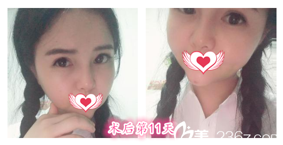 去安徽维多利亚整形外科医院找徐和林做双眼皮综合整形+鼻综合+下巴整形术后第11天恢复效果 去安徽维多利亚整形外科医院找徐和林做双眼皮综合整形+鼻综合+下巴整形术后第11天恢复效果