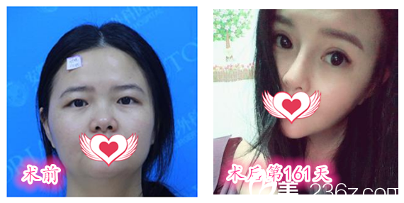 找安徽维多利亚整形美容医院徐和林院长做全切双眼皮眼综合+硅胶隆鼻鼻综合+下颌角整形前后对比图 找安徽维多利亚整形美容医院徐和林院长做全切双眼皮眼综合+硅胶隆鼻鼻综合+下颌角整形前后对比图
