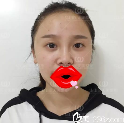 在连天美做双眼皮手术前 在连天美做双眼皮手术前