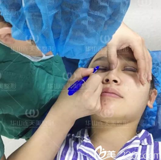 杭州连天美姜鑫利设计双眼皮方案 杭州连天美姜鑫利设计双眼皮方案