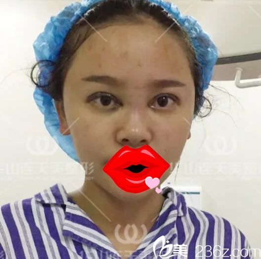 10mm双眼皮手术即刻效果图 10mm双眼皮手术即刻效果图