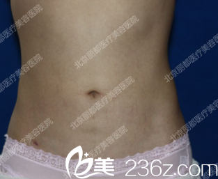 吸脂后一个月照片 吸脂后一个月照片