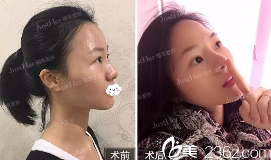 广州珈禾医疗美容整形医院鼻综合隆鼻案例