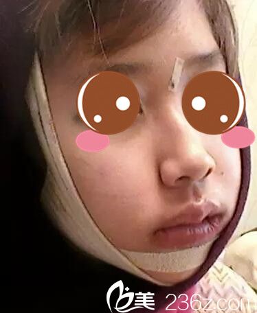 真人案例术后第二天