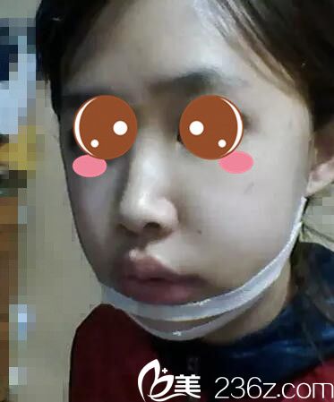 真人案例术后第七天