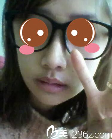 真人案例术后二十天