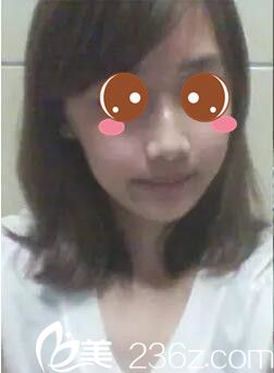 真人案例术后一个月