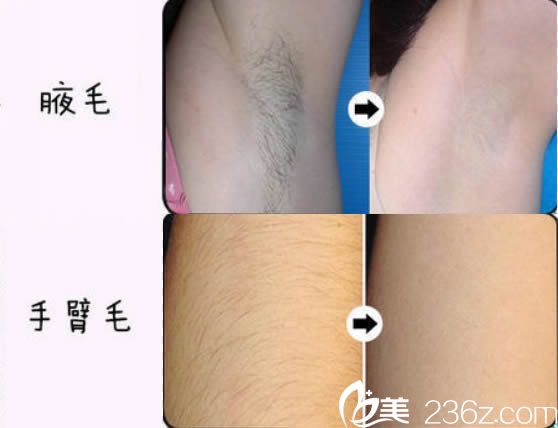 激光脱腋毛和手臂脱毛真人案例 激光脱腋毛和手臂脱毛真人案例