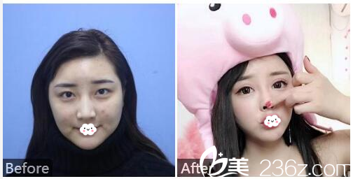 广州紫馨李政祐做的双眼皮案例