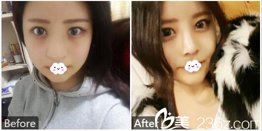 广州天姿单永鹏隆鼻案例 广州天姿单永鹏隆鼻案例