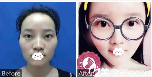 广州天姿单永鹏双眼皮和脂肪填充案例 广州天姿单永鹏双眼皮和脂肪填充案例