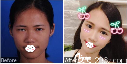 广州天姿单永鹏面部埋线提升案例 广州天姿单永鹏面部埋线提升案例