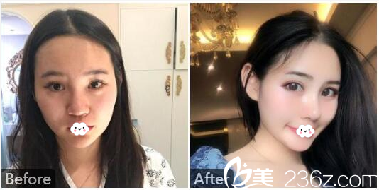 广州美莱整形医院罗延平膨体隆鼻和自体软骨隆鼻效果图