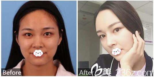 广州美莱整形医院<!--<i data=20240703-sp></i>-->隆鼻效果图 广州美莱整形医院<!--<i data=20240703-sp></i>-->隆鼻效果图