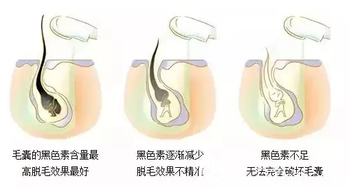 冰点脱毛原理示意图 冰点脱毛原理示意图