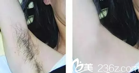 绵阳朗睿整形脱腋毛案例 绵阳朗睿整形脱腋毛案例
