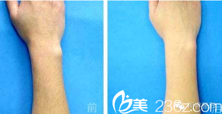 绵阳朗睿上臂脱毛案例 绵阳朗睿上臂脱毛案例