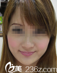 在沈阳孟强美容诊所注射瘦脸针一个月后我终于摆脱了嘟嘟脸！