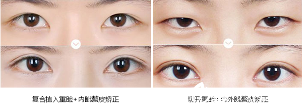 内江达芬奇整形双眼皮术后效果对比照