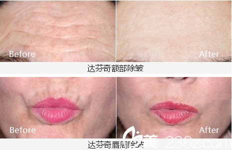 内江达芬奇整形医院除皱案例 内江达芬奇整形医院除皱案例